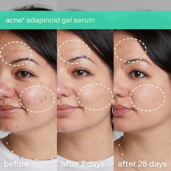 NEW✅ Skinfix Acne+ Adapinoid Gel with Niacinamide + Squalane - Picture 3 of 7